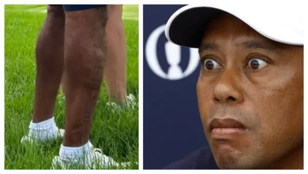 Bombshell Revelation: Tiger Woods’ Battered Leg Unveiled for the First Time Since Devastating Car Crash